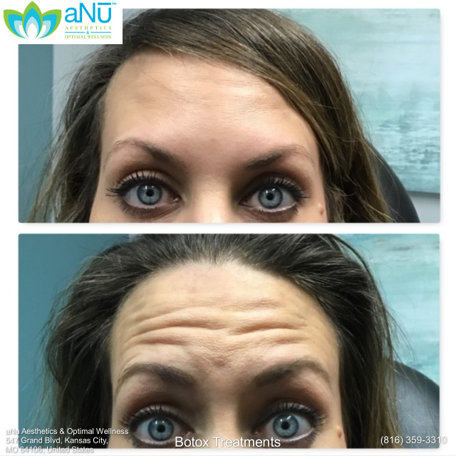 Forehead before and after botox at aNu Aesthetics
