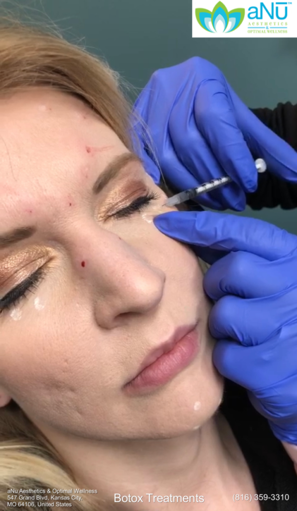 A woman's face about to be injected with botox