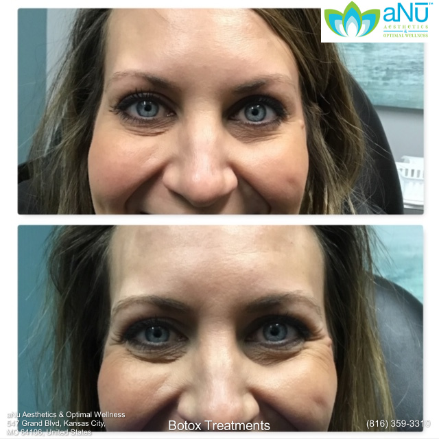 Woman's face before and after botox at aNu Aesthetics
